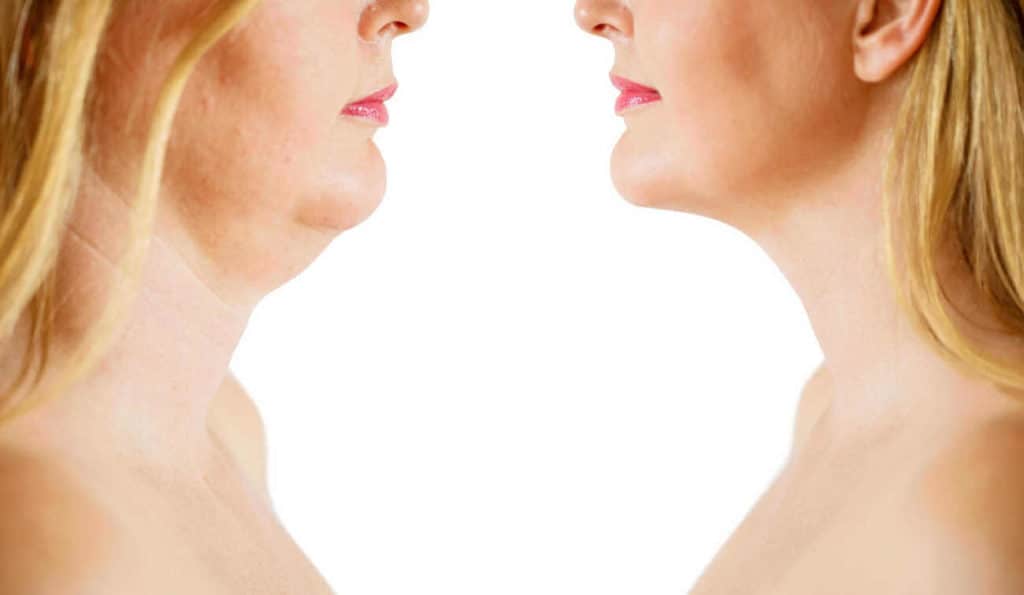 Double Chin treatment Ramsey before and after results