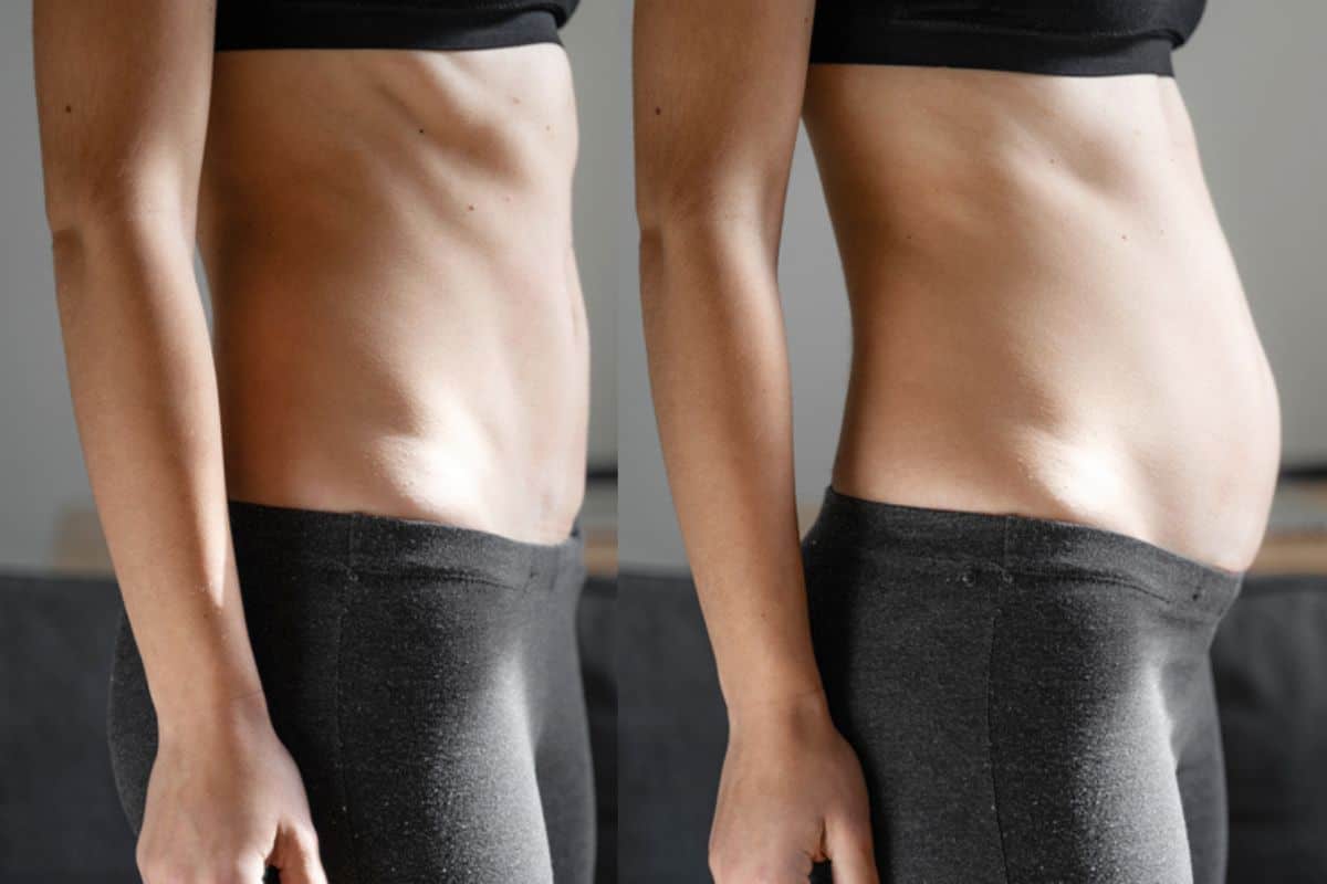 How long does diastasis recti take to improve Ramsey?