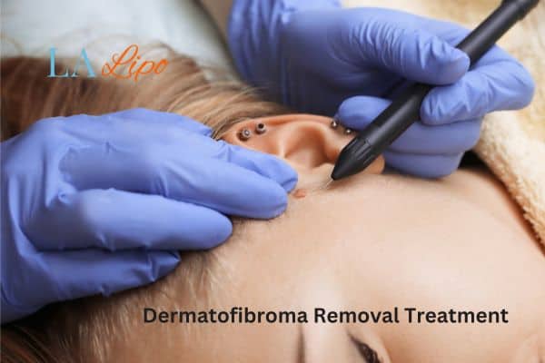 Dermatofibroma Removal Treatment Ramsey