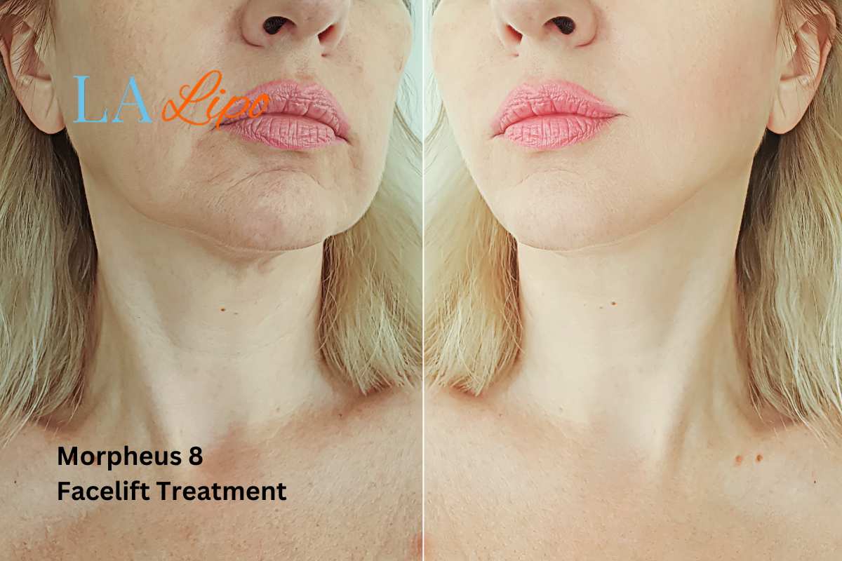 Turn back time with Morpheus8 Treatment Ramsey