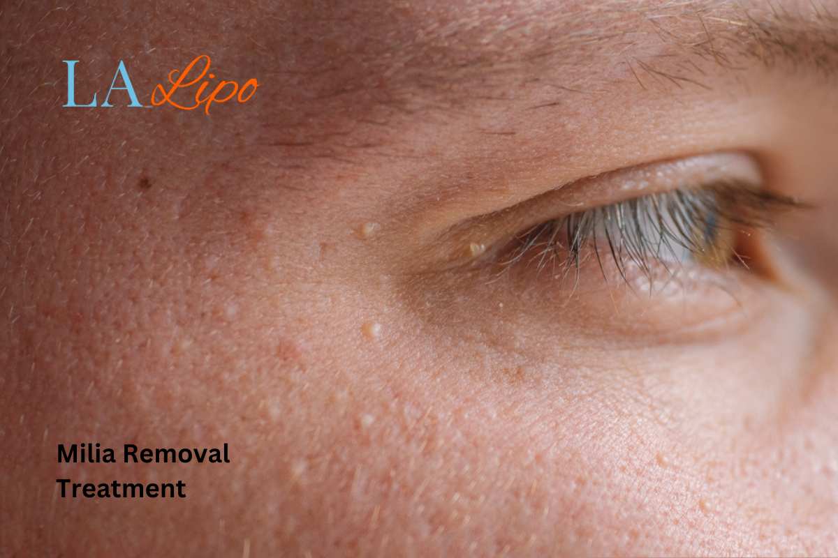 Cryopen Milia Removal: Is It the Easiest and Safest Option Ramsey?
