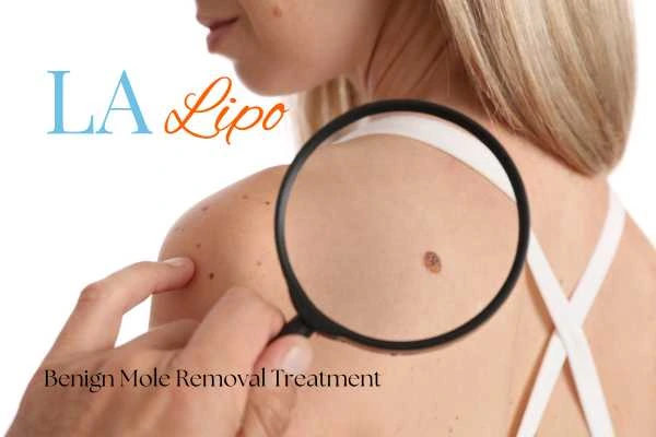 Woman having her inspection of blemish before mole removal Ramsey