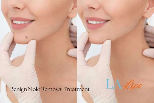 Before and after mole removal Ramsey treatment