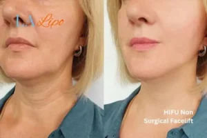 hi-fu for wrinkles Ramsey before and after results