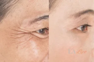Before and after results of woman - HI-fu wrinkles reduction treatment Ramsey