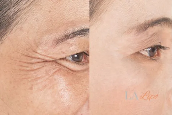 Before and after results of woman - HI-fu wrinkles reduction treatment Ramsey