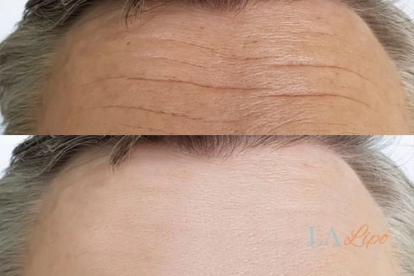 results of HIFU Ramsey on mans forehead to help reduce lines and wrinkles