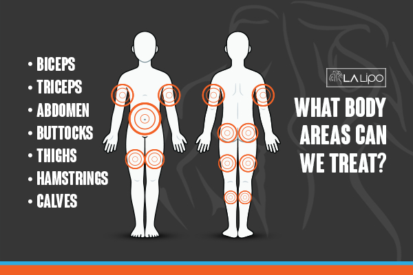 Graphic to show areas you can have LA-EMS Body Sculpting Ramsey treatment.