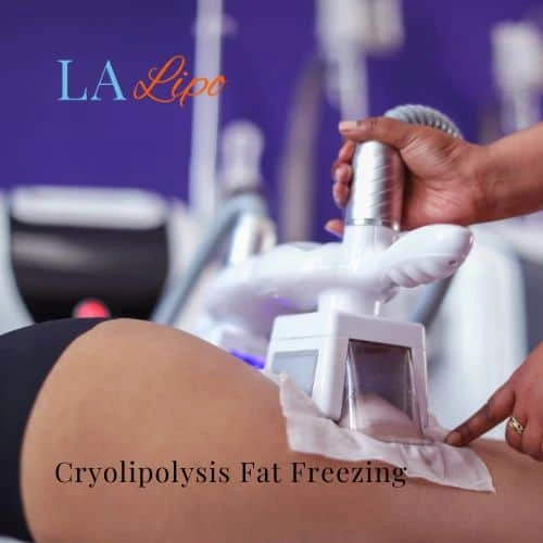 fat freezing - Cryolipolysis Ramsey
