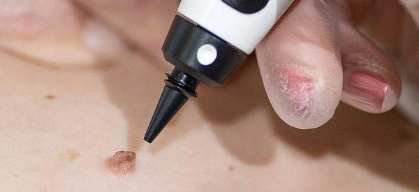 skin tag removal using cryopen Ramsey
