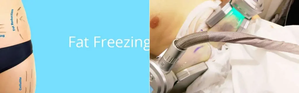 Fat freezing Ramsey on multiple areas of the body