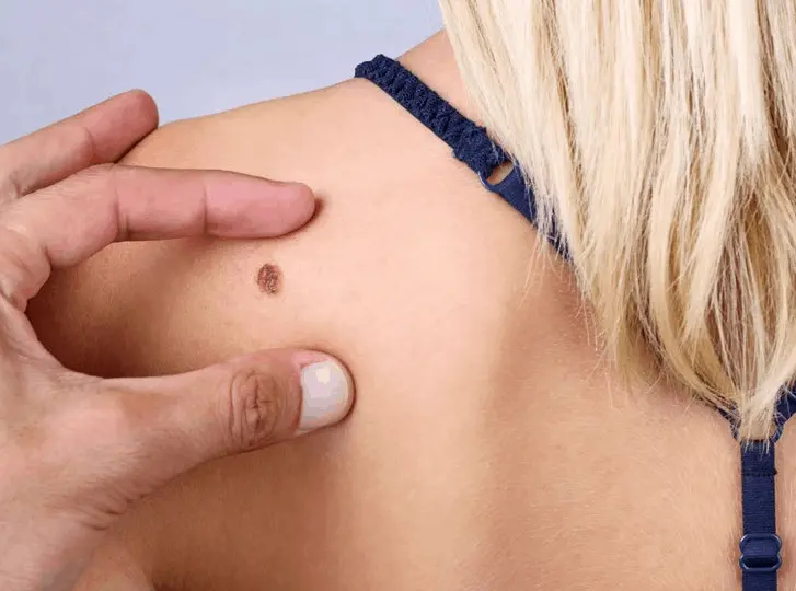 woman having mole removal Ramsey consultation before treatment.