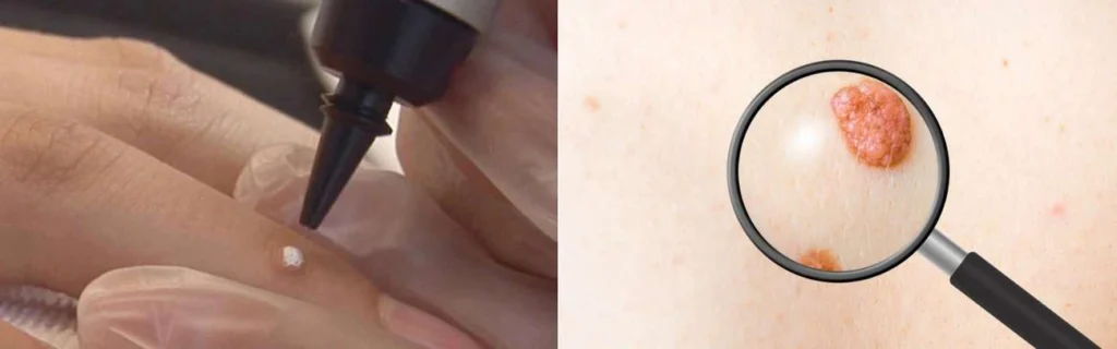 Person getting moles removed with cryopen Ramsey