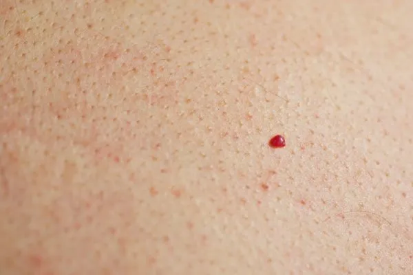 close up of a cherry angioma Ramsey