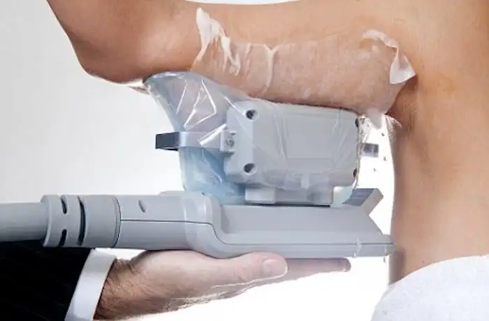 Picture of fat freezing Ramsey on the upper arms.