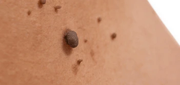 image of a skin tag Ramsey