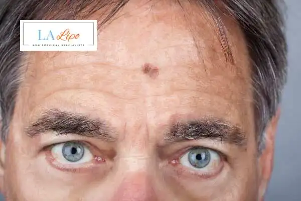Solar Lentigo Removal Ramsey image of man with mark on his forehead