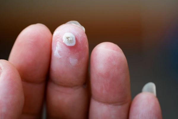 wart on person finger - cryotherapy to treat from LA LIPO Ramsey