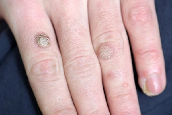 photo of warts on person hand - see wart removal Ramsey from LA LIPO
