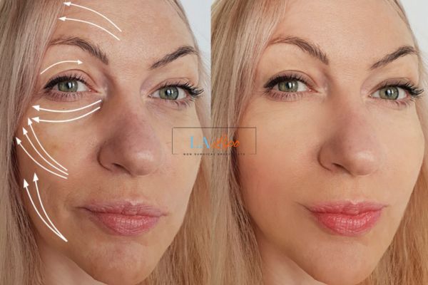 Morpheus 8 results Ramsey face lift.