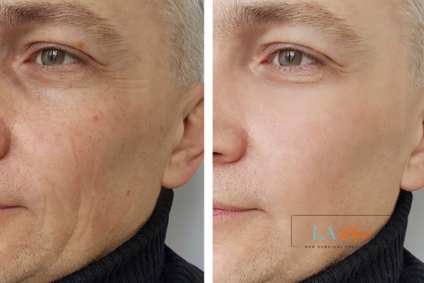 See the amazing results of Morpheus8 Treatment Ramsey!