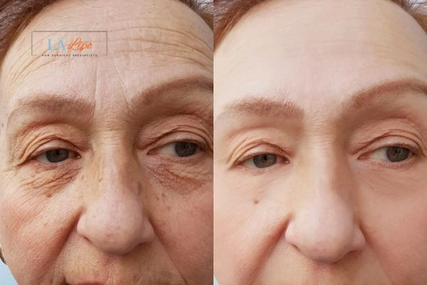 The powerful benefits of Morpheus8 Treatment Ramsey - Call Our team today!