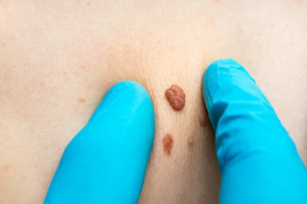 LA LIPO Cryopen Lesion Removal Prices Ramsey