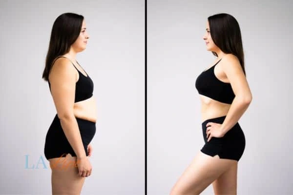 Picture of womans before and after using LA-EMS body sculpting to improve her core strength Ramsey