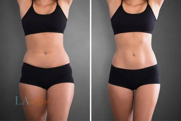 before and after results of non-surgical treatment to help a woman's body image and mental health Ramsey