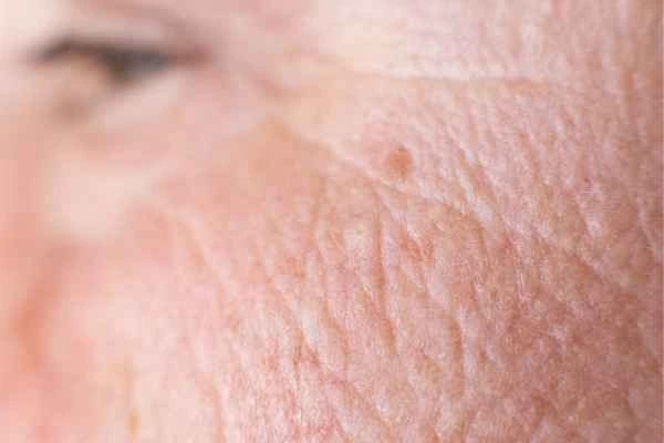 close up picture of a woman's face showing an age spot Ramsey