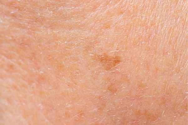 close up picture of age spots Ramsey