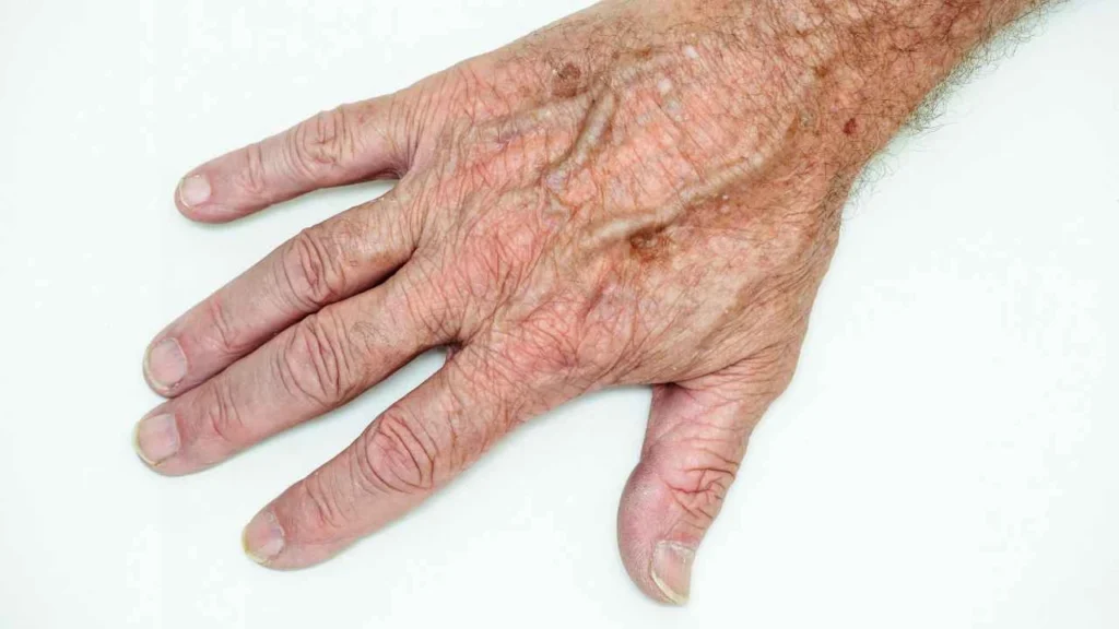 Male hand showing age spot Ramsey