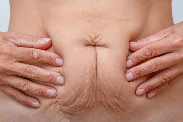 Should I Combine Diastasis Recti Treatment with Body Contouring for Better Results Ramsey?
