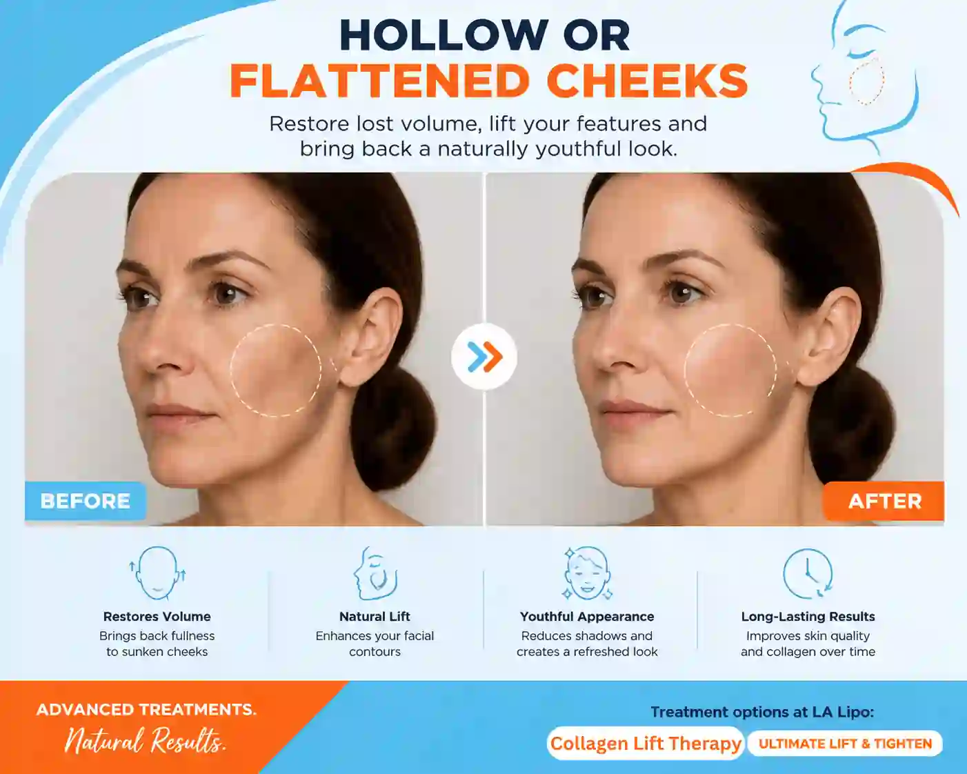 Sign #4: Hollow or Flattened Cheeks Ramsey