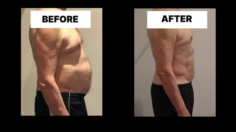 What Symptoms Can Diastasis Recti Cause in Men? Weak Core, Back Pain and Poor Posture Ramsey